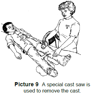 Special cast saw is used to remove cast