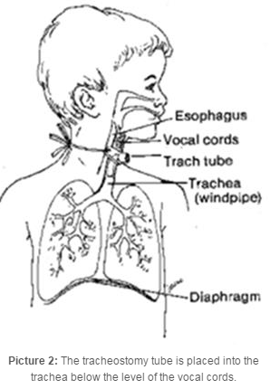 where the vocal chords and trachea are located
