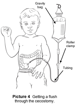 Line drawn picture of a child getting a flush through the cecostomy by using a gravity bag