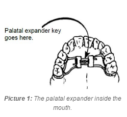the palatal expander inside the mouth