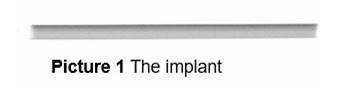 Nexplanon Implant