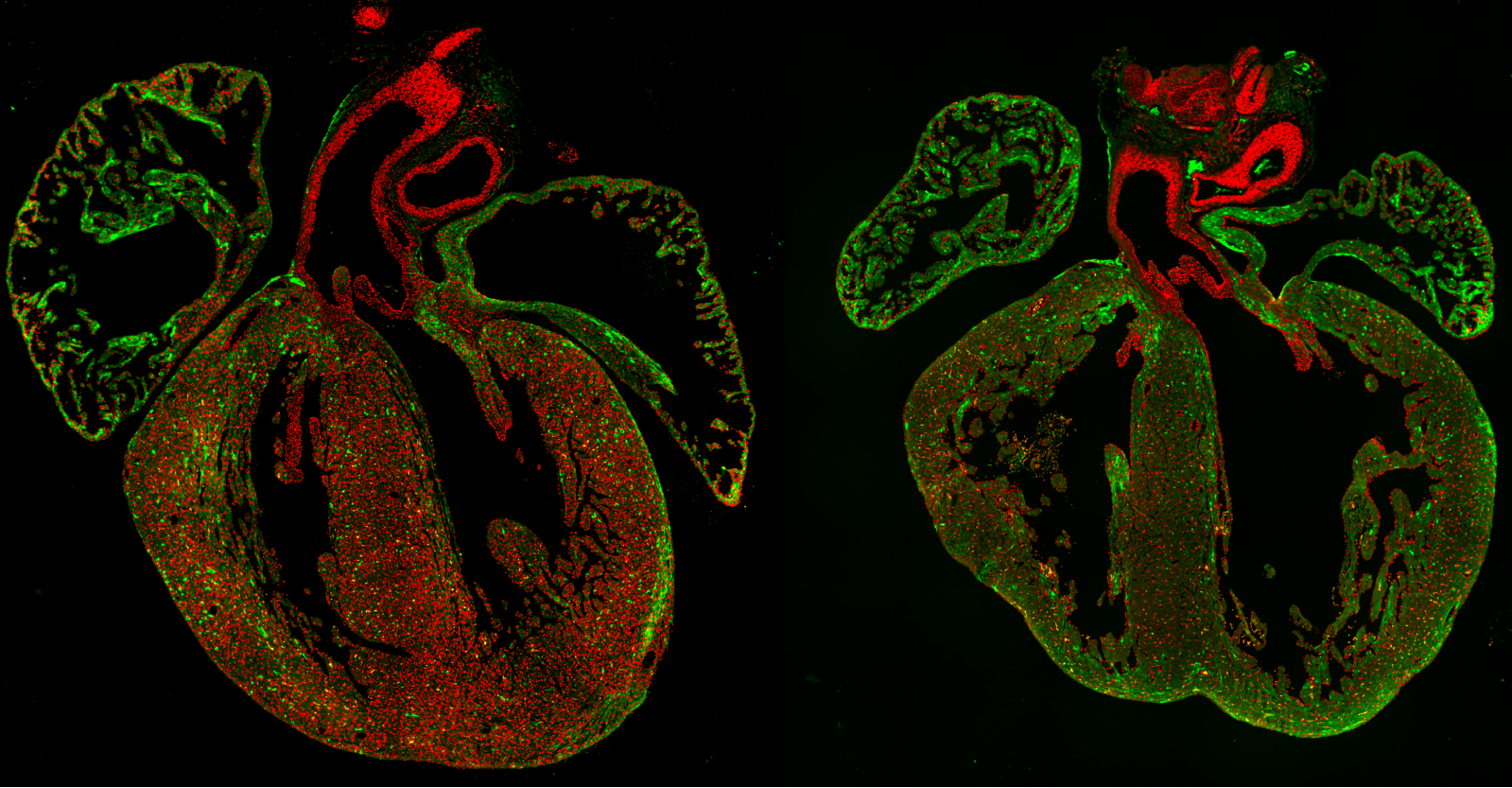 A human heart. Cardiomyocyte specific deletion of methyltransferases causes early-onset dilated cardiomyopathy