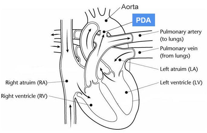 Patent Ductus Arteriosus (PDA)