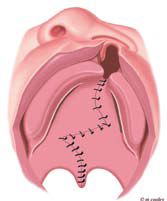 Cleft Palate Surgery