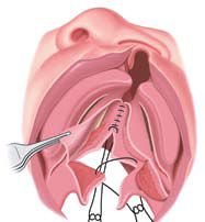 Cleft Palate Surgery
