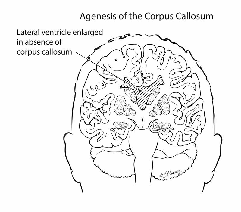 Agenesis Corpus Callosum