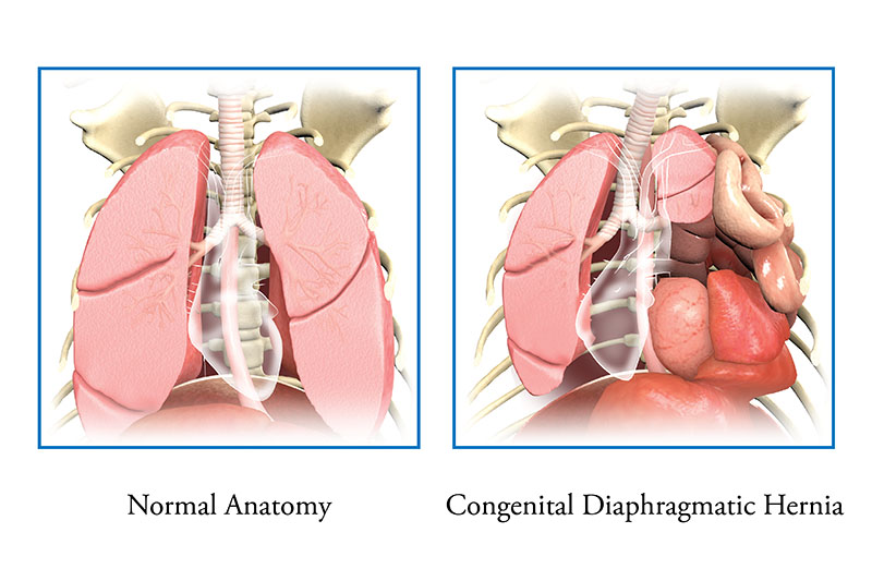 Congenital Diaphragmatic Hernia