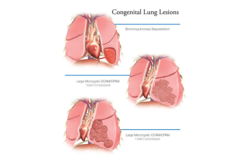 Congenital Lung Lesions