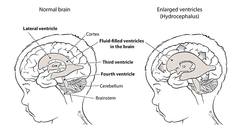 Hydrocephalus