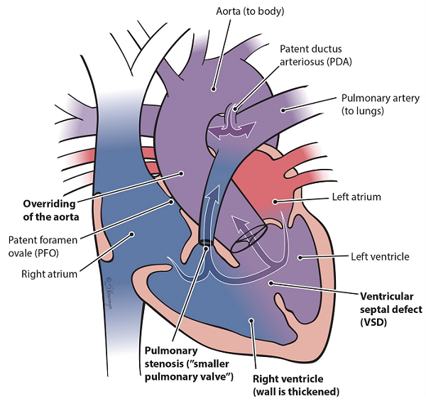 Heart illustration of tetralogy of Fallot