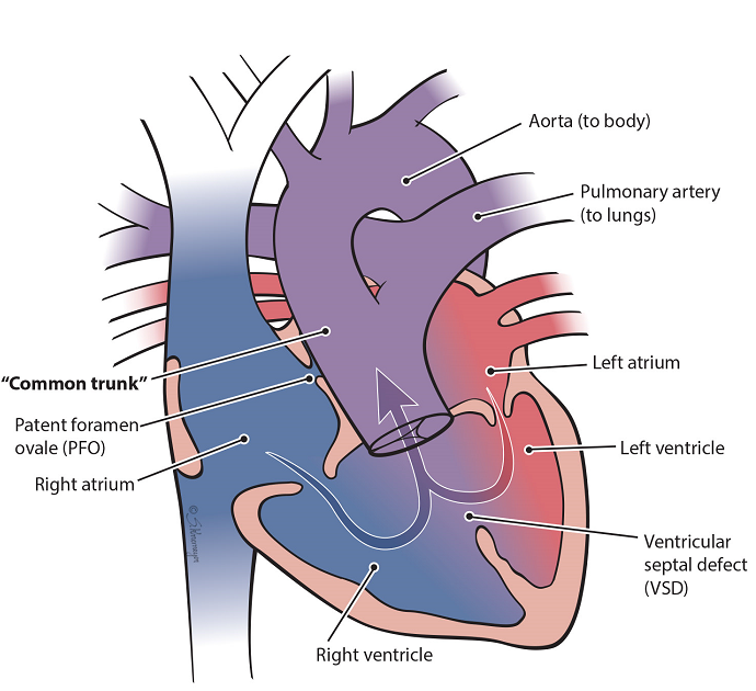 Heart illustration of truncus arterious