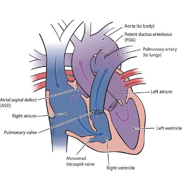 Heart illustration of Ebstein's anomaly