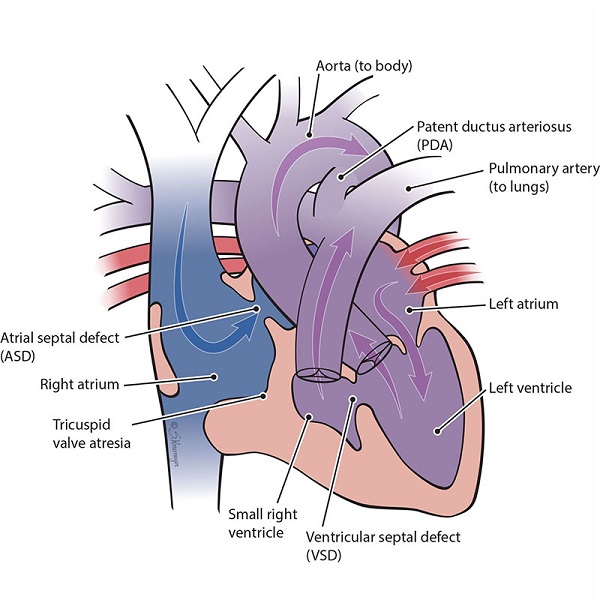 Illustration of a heart with tricuspid atresia with normally related great arteries defect