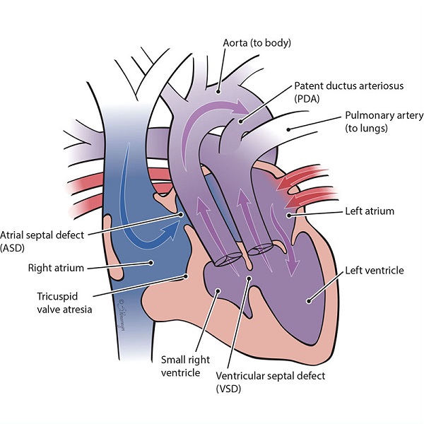 Illustration of a heart with tricuspid atresia with transposition of the great arteries defect
