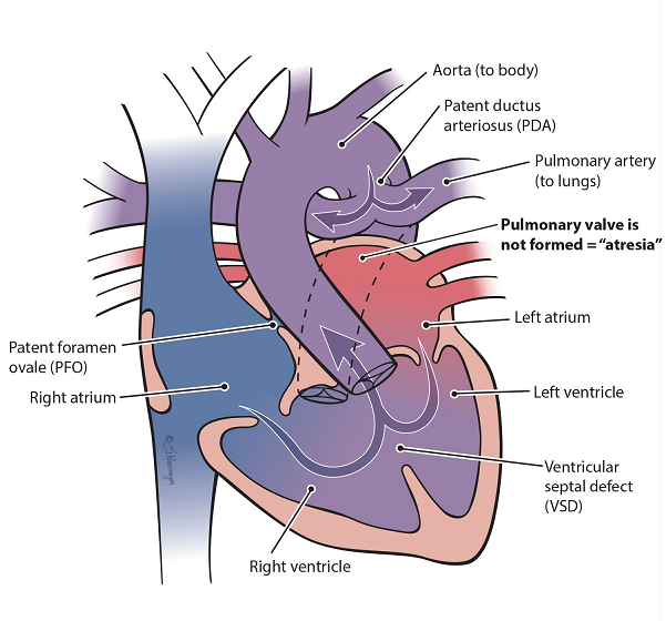 Heart illustration of pulmonary valve not formed (atresia)