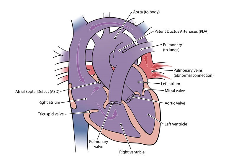 Illustration of Total Anomalous Pulmonary Venous Return Congenital Heart Defect
