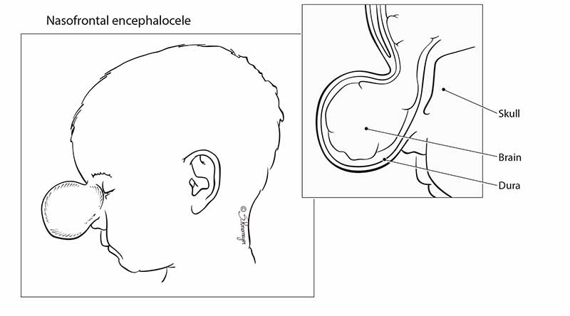 Nasofrontal Encephalocele
