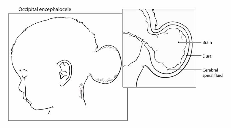 Occipital Encephalocele