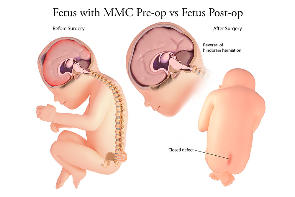 Closure of the myelomeningocele can result in reversed hindbrain herniation.