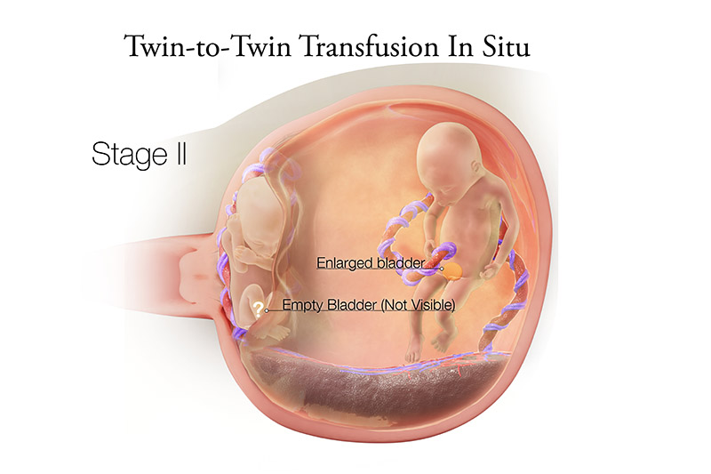 Twin to Twin Transfusion Syndrome Stage 2