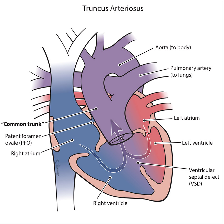 Truncus Arteriosus