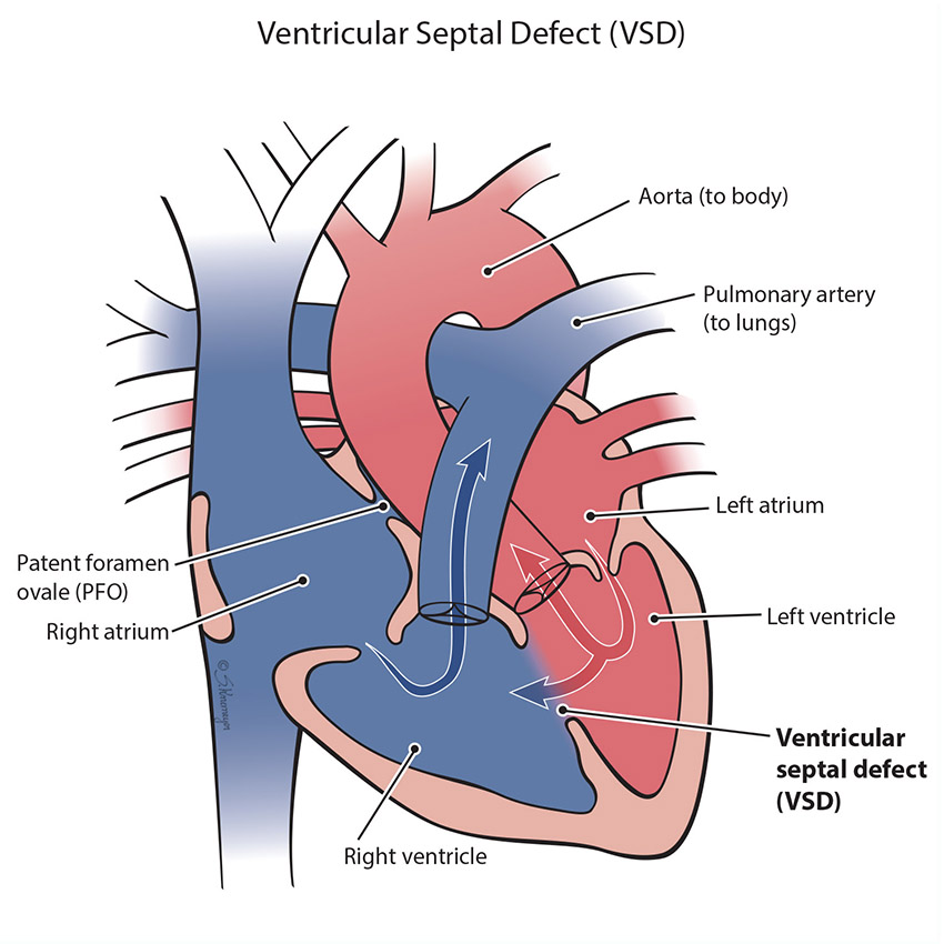 Ventricular Septal Defect