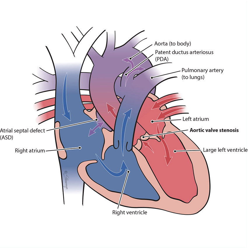 Aortic Stenosis