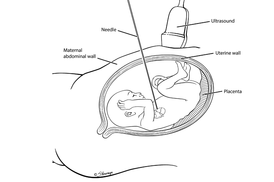 Fetal Cardiac Intervention