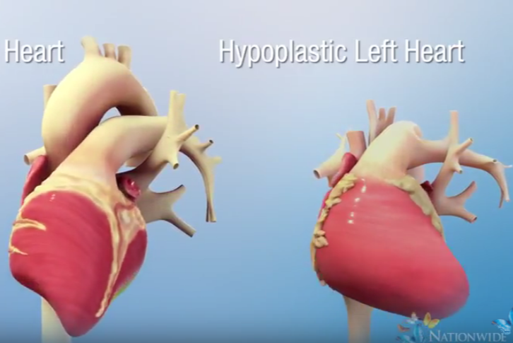 Normal Heart vs. Hypoplastic Left Heart Syndrome