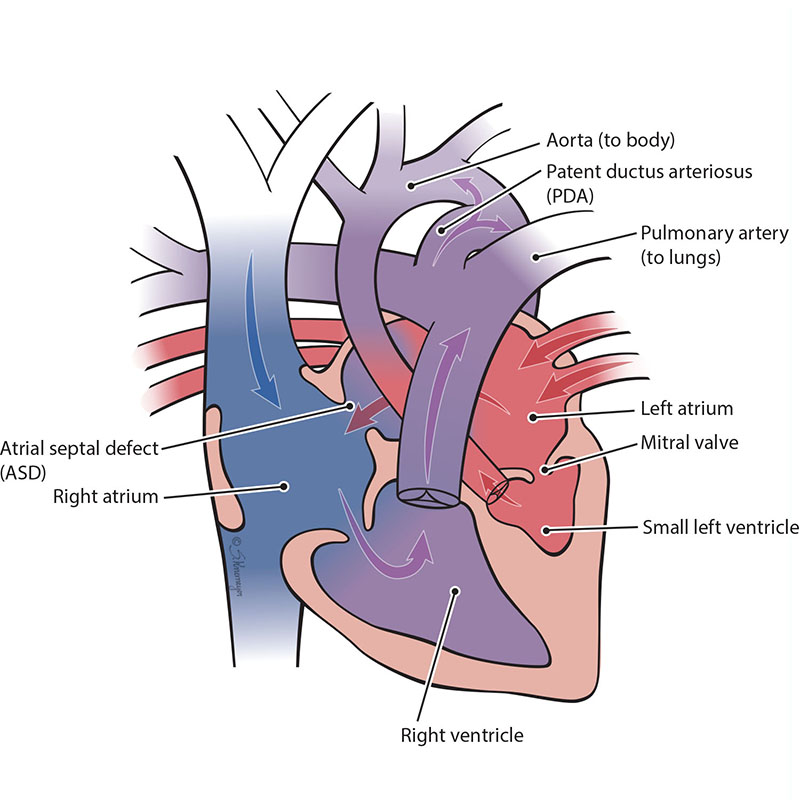 Hypoplastic Left Heart Syndrome