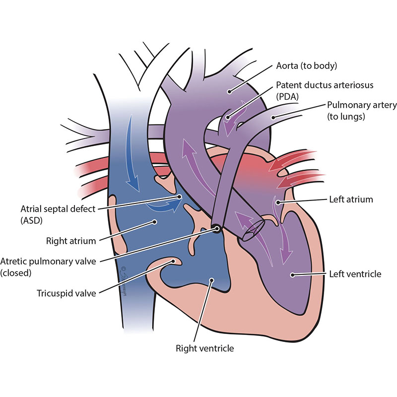 Pulmonary Atresia with Intact Ventricular Septum