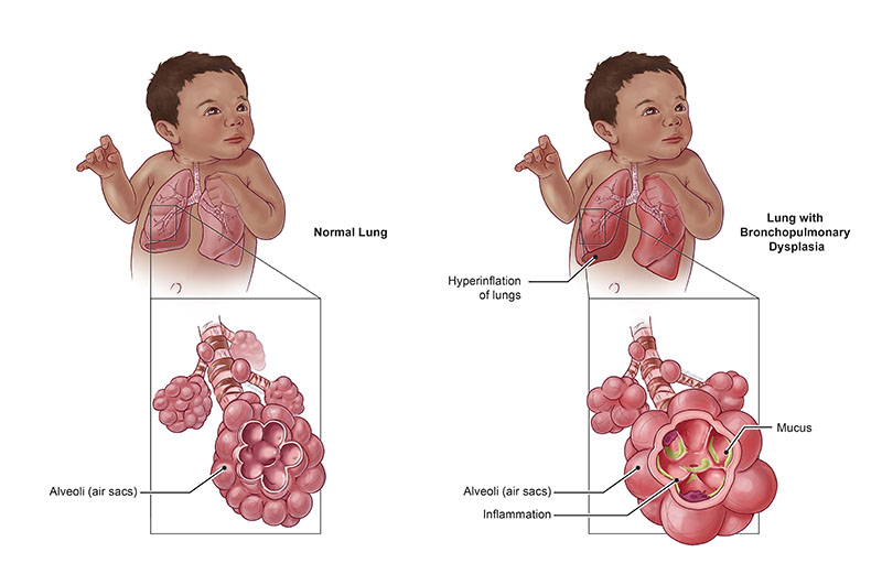 Illustration comparing a normal lung to a lung with bronchopulmonary dysplasia (BPD)