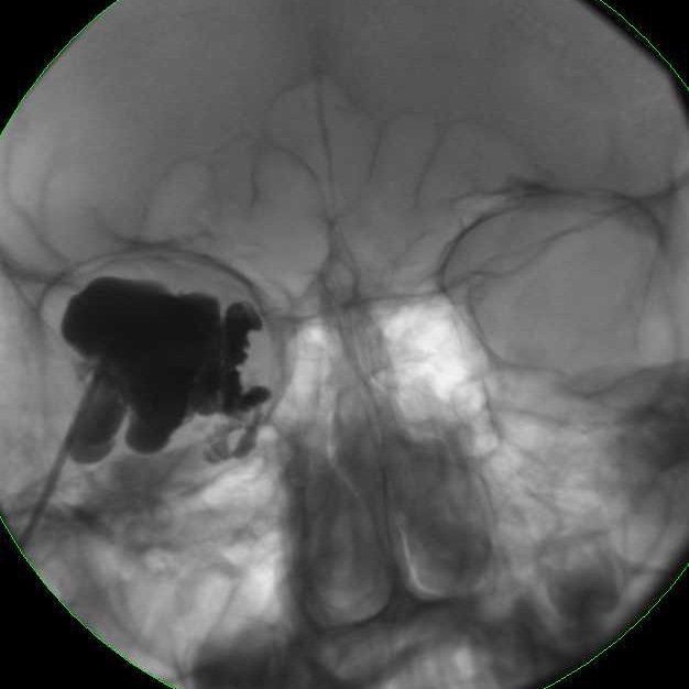 Jim Murakami, MD, ISSVA Presentation