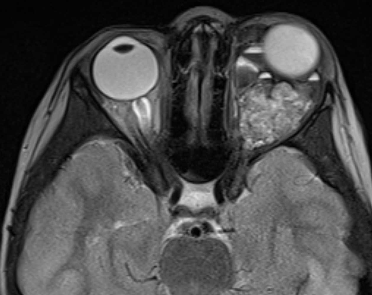 Jim Murakami, MD, ISSVA Presentation
